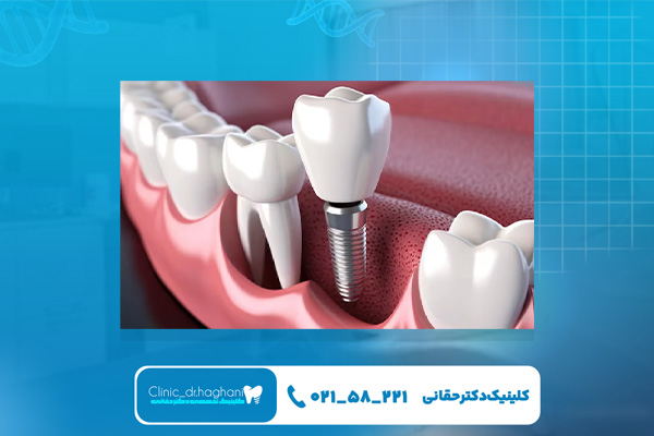 انواع مختلف ایمپلنت دندان انواع مختلف ایمپلنت دندان