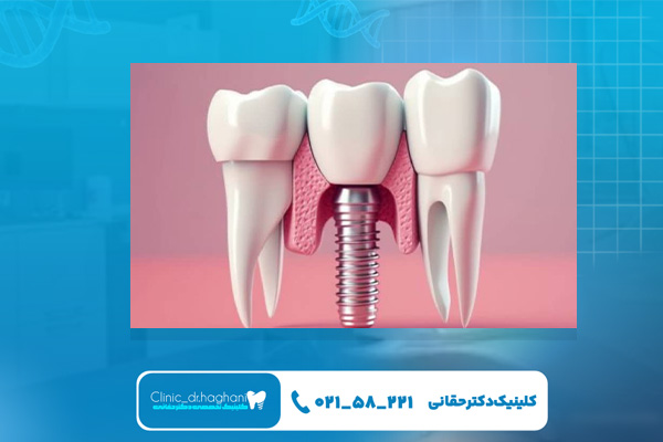 دندانپزشکی ایمپلنت در تهران دندانپزشکی ایمپلنت در تهران