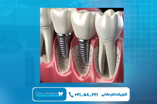 کلینیک دندانپزشکی دکتر حقانی، مرکز تخصصی ایمپلنت در تهران کلینیک دندانپزشکی دکتر حقانی، مرکز تخصصی ایمپلنت در تهران
