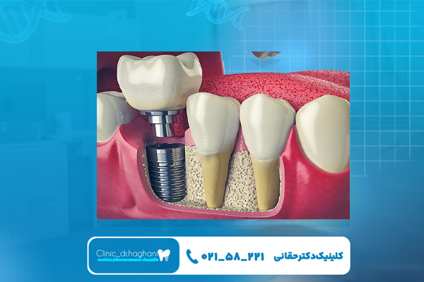 دندانپزشکی ایمپلنت دندانپزشکی ایمپلنت