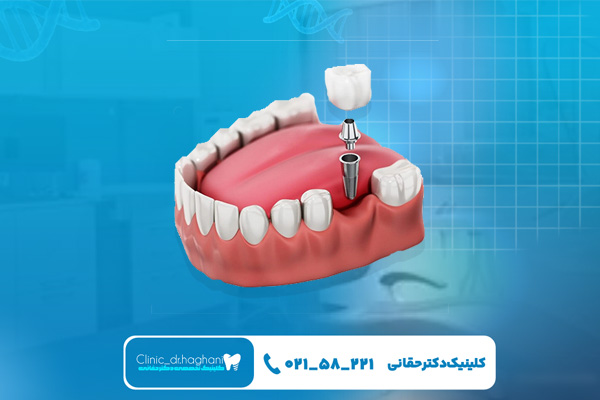 دندانپزشکی ایمپلنت در تهران دندانپزشکی ایمپلنت در تهران