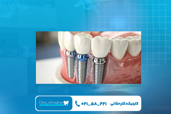 مزایای استفاده از دندانپزشکی ایمپلنت غرب تهران مزایای استفاده از دندانپزشکی ایمپلنت غرب تهران