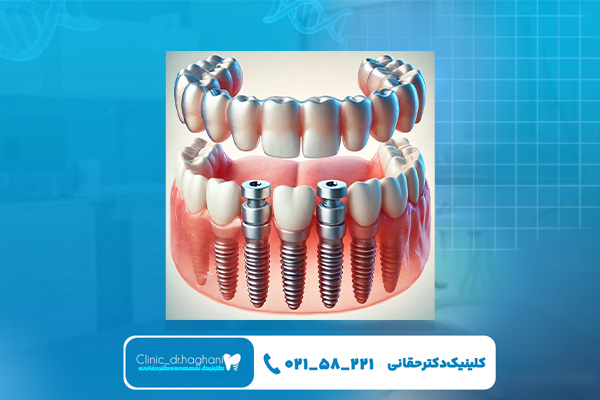 انواع کاشت ایمپلنت انواع کاشت ایمپلنت