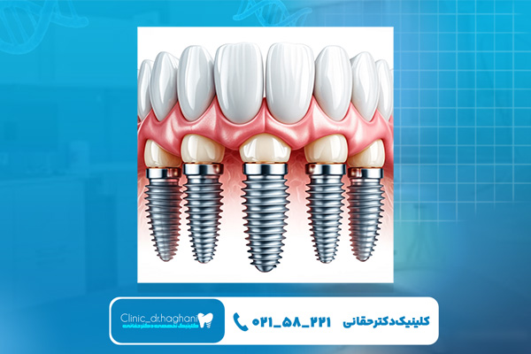 دندانپزشکی تخصصی ایمپلنت غرب تهران دندانپزشکی تخصصی ایمپلنت غرب تهران