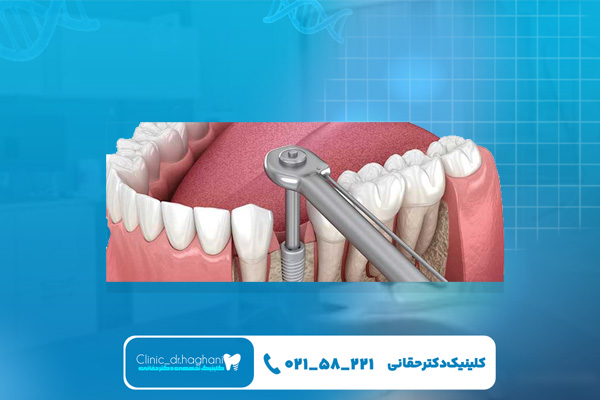 طول عمر ایمپلنت دندان چقدر است؟