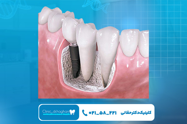 طول عمر ایمپلنت دندان چقدر است؟