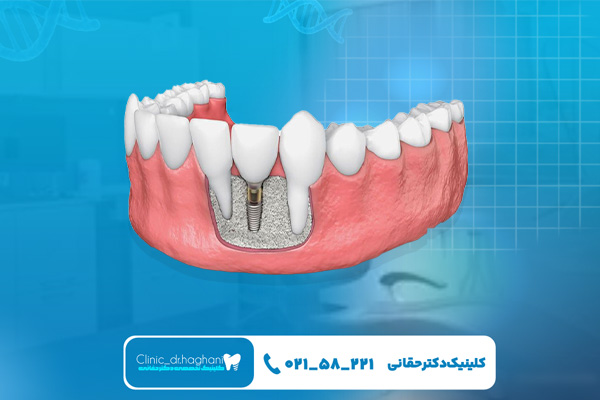 طول عمر ایمپلنت دندان چقدر است؟