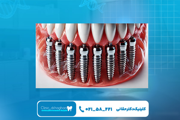 طول عمر ایمپلنت سوئیسی