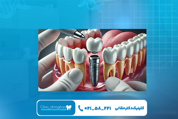 ایمپلنت‌ سوئیسی در کلینیک دندانپزشکی دکتر حقانی