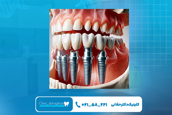 فرق طول عمر ایمپلنت‌ سوئیسی با سایر برندها