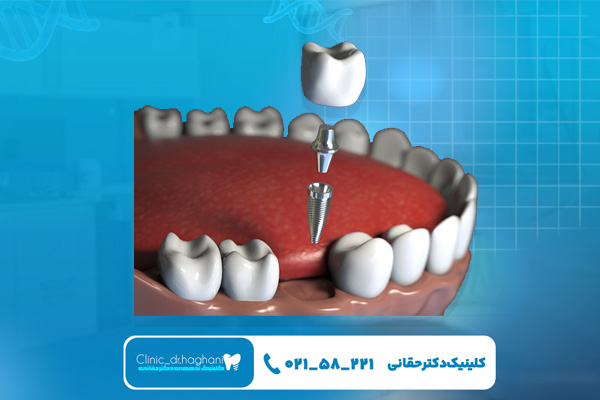 ایمپلنت فوری دندان