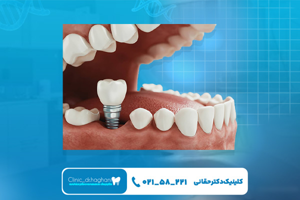 تفاوت ایمپلنت فوری و معمولی