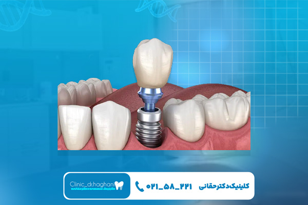  کاشت ایمپلنت در کلینیک دندانپزشکی دکتر حقانی