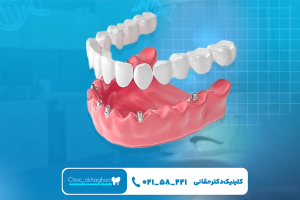 مراقبت های بعد از ایمپلنت‌ دندان