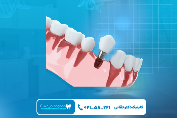 مراقبت های بعد از ایمپلنت‌ دندان