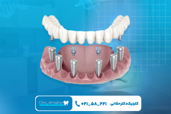 مراقبت های بعد از ایمپلنت‌ دندان