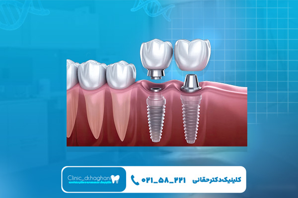 مرکز ایمپلنت بدون درد