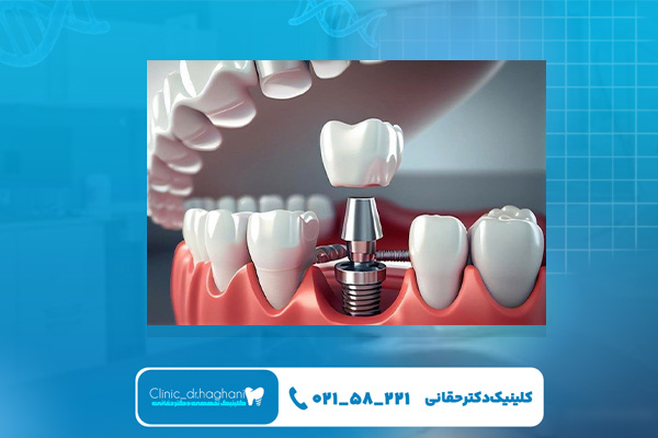 مرکز ایمپلنت بدون درد