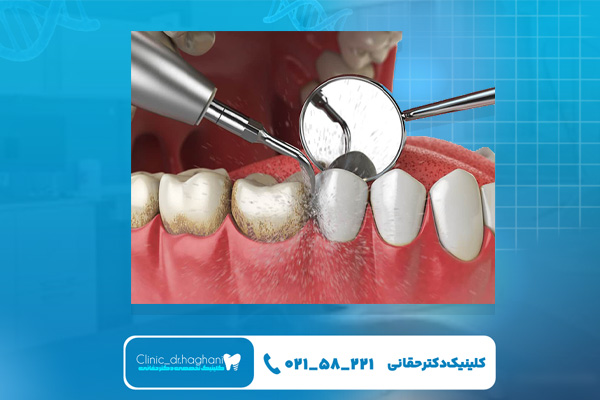 سفیدی دندانها در مرکز تخصصی دندانپزشکی سفیدی دندانها در مرکز تخصصی دندانپزشکی