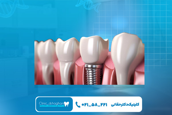 مراحل انجام کاشت ایمپلنت دندان