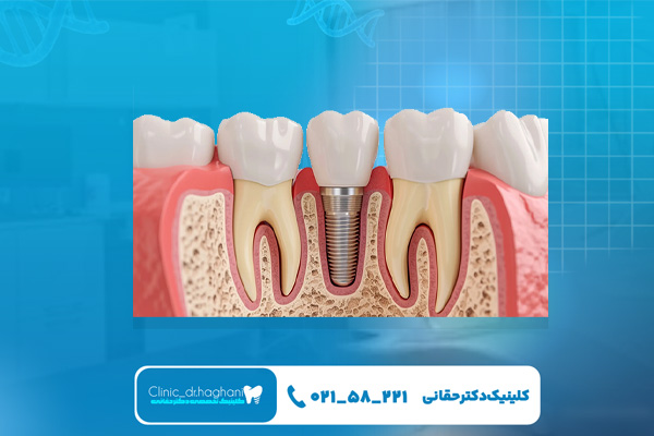 انواع ایمپلنت دندان