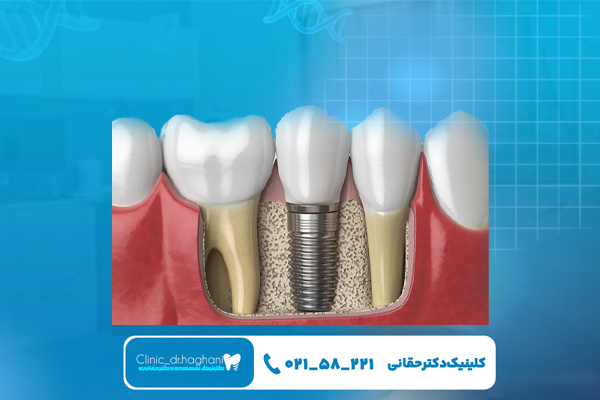 مرکز تخصصی کاشت دندان تهران