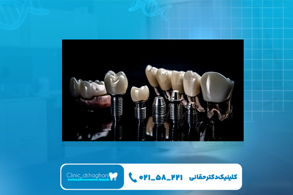 تفاوت درانجام ایمپلنت دیجیتال و سنتی تفاوت درانجام ایمپلنت دیجیتال و سنتی