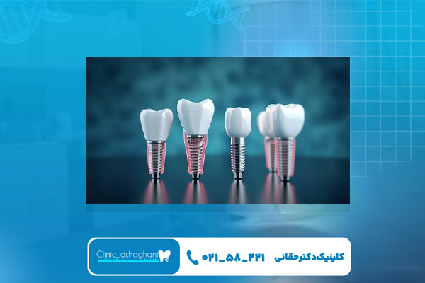 مزایای ایمپلنت دیجیتال نسبت به سنتی مزایای ایمپلنت دیجیتال نسبت به سنتی