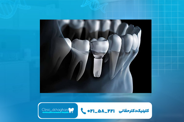 مزایای ایمپلنت دیجیتال نسبت به سنتی از نظر قیمت مزایای ایمپلنت دیجیتال نسبت به سنتی از نظر قیمت