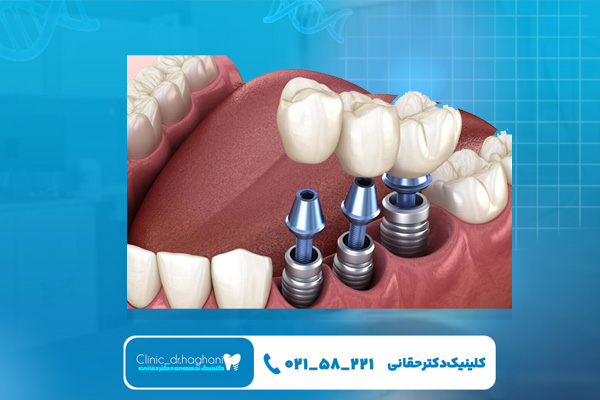 مقایسه قیمت ایمپلنت کره ای و سوییسی