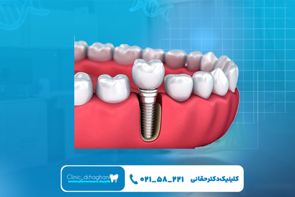 مقایسه قیمت ایمپلنت کره ای و سوییسی