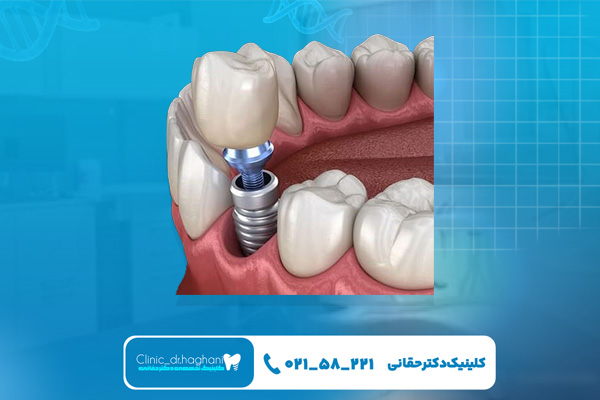 مهمترین مراقبت های بعد از ایمپلنت دندان