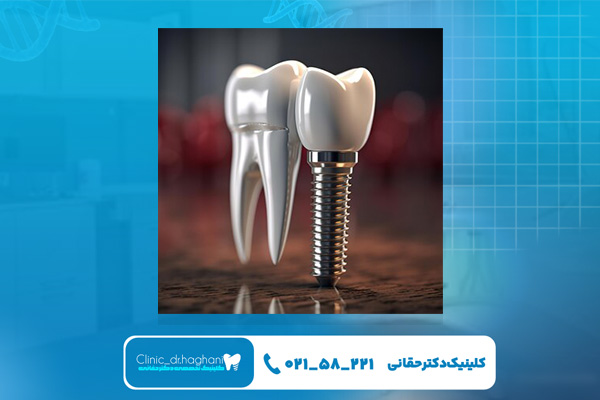 مراحل مختلف کاشت ایمپلنت آمریکایی مراحل مختلف کاشت ایمپلنت آمریکایی