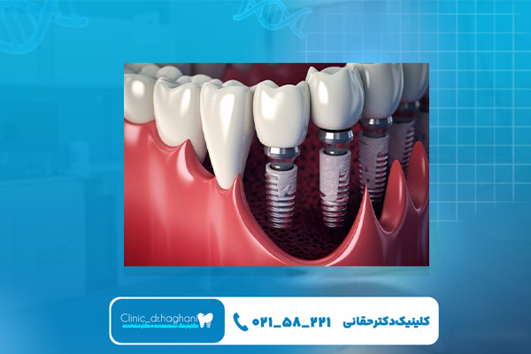 مزیتهای استفاده از ایمپلنت آمریکایی مزیتهای استفاده از ایمپلنت آمریکایی