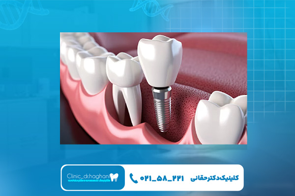 چند نوع ایمپلنت دندان وجود دارد؟