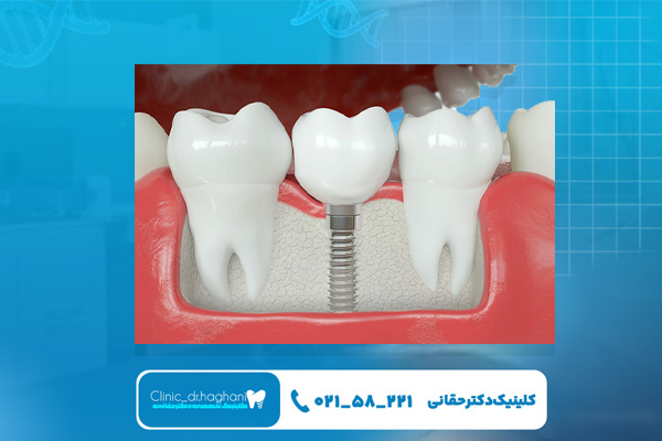 چند نوع ایمپلنت دندان وجود دارد؟