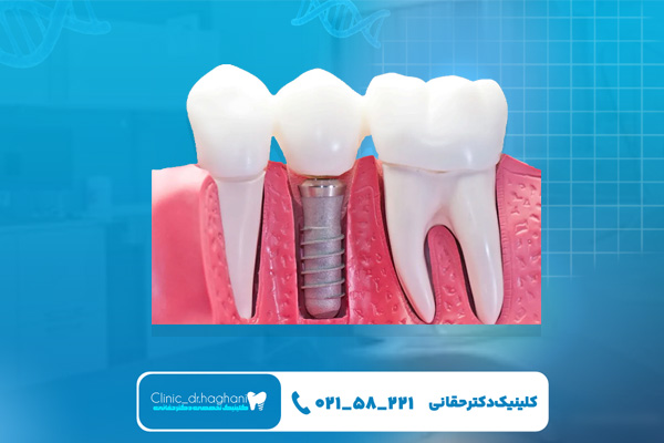 چند نوع ایمپلنت دندان وجود دارد؟