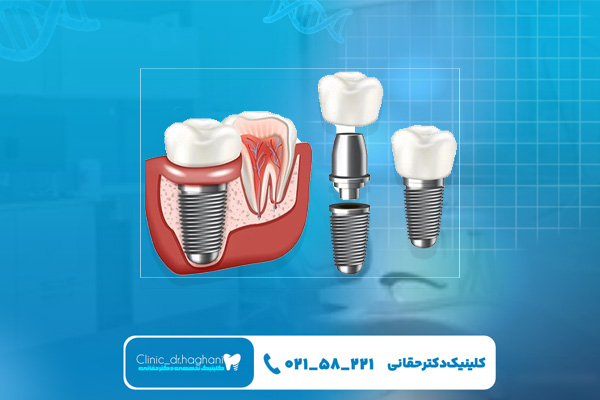 چه غذاهایی بعد از ایمپلنت نباید خورد؟