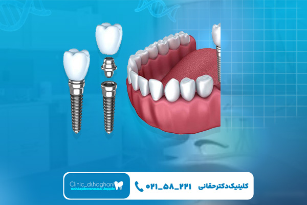 چه غذاهایی بعد از ایمپلنت نباید خورد؟