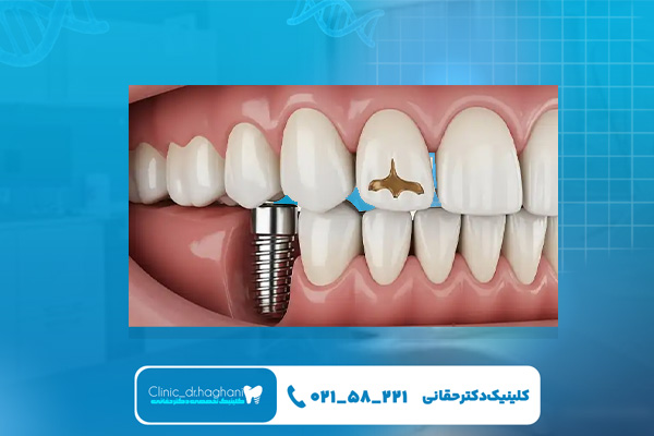 چگونه از ایمپلنت‌ دندان مراقبت کنیم؟