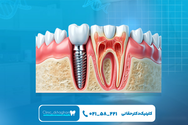 چگونه از ایمپلنت‌ دندان مراقبت کنیم؟