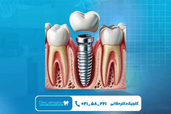 چگونه از ایمپلنت‌ دندان مراقبت کنیم؟