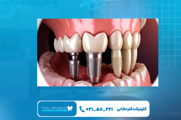 هزینه کاشت دندان دیجیتال در تهران