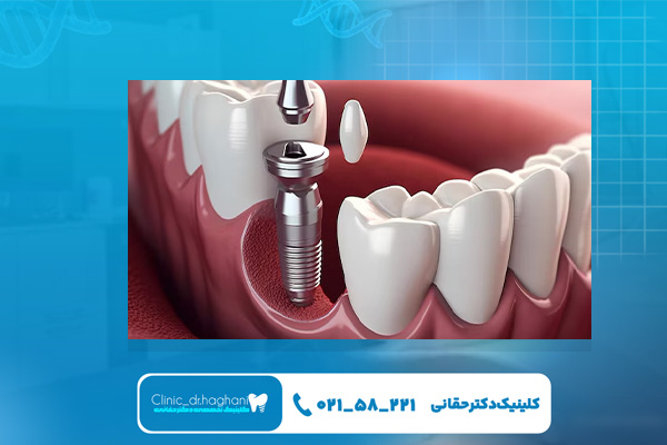 مراحل انجام کاشت دندان دیجیتال