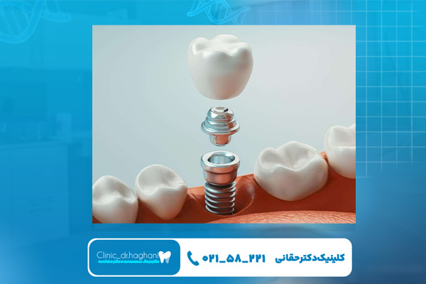 کاشت دندان دیجیتال در تهران