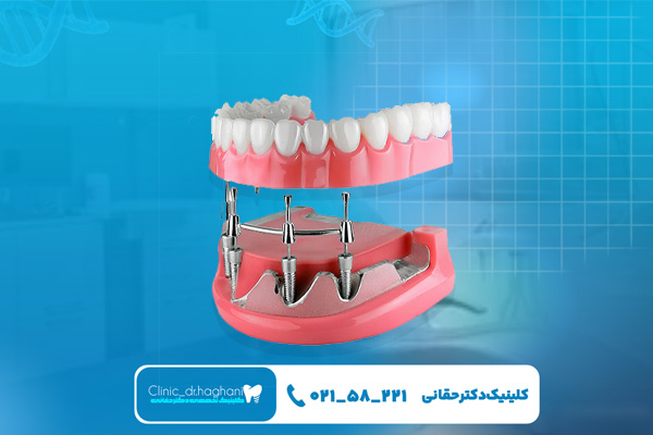 ایمپلنت دندان دیجیتال