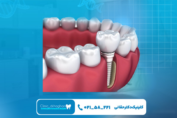 مزیت‌های کاشت دندان دیجیتال