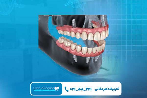 چه کسانی واجد شرایط ایمپلنت دیجیتال دندان هستند؟