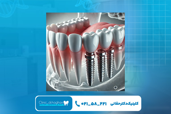 مزیت‌های کاشت ایمپلنت دندان