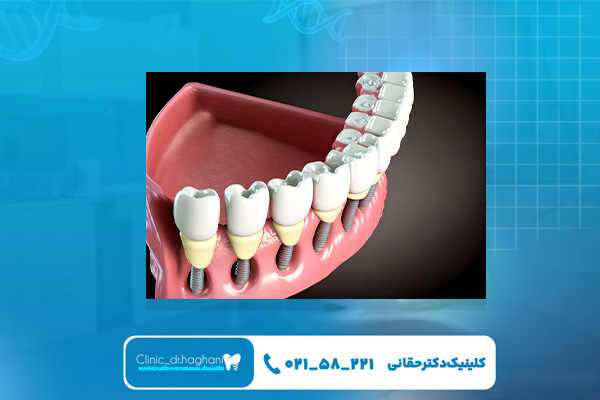 کاشت ایمپلنت در کلینیک دکتر حقانی